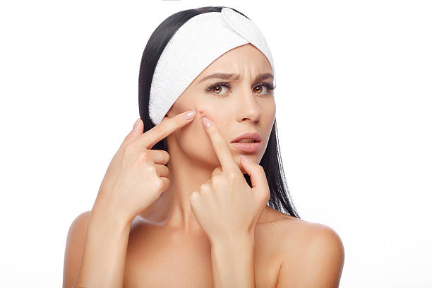 Acne aur Pimples ka Ilaj: Home Remedies Jo Hamesha Kaam Karein